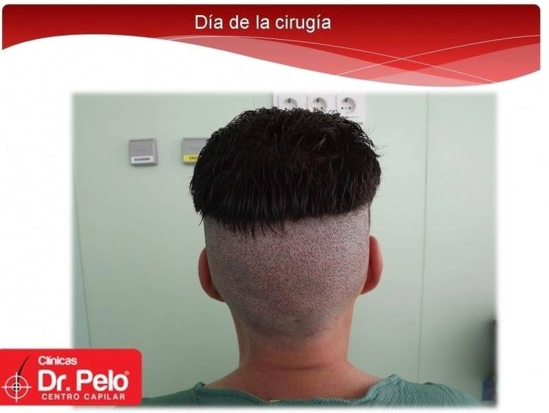 injerto capilar fue
