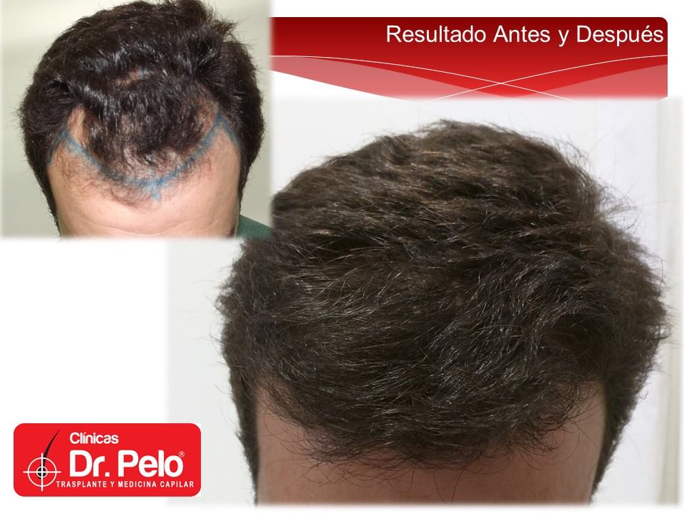injerto-capilar-tecnica-fue-dr-afonso-junior-clinicas-dr-pelo (17)