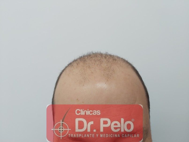 injerto capilar