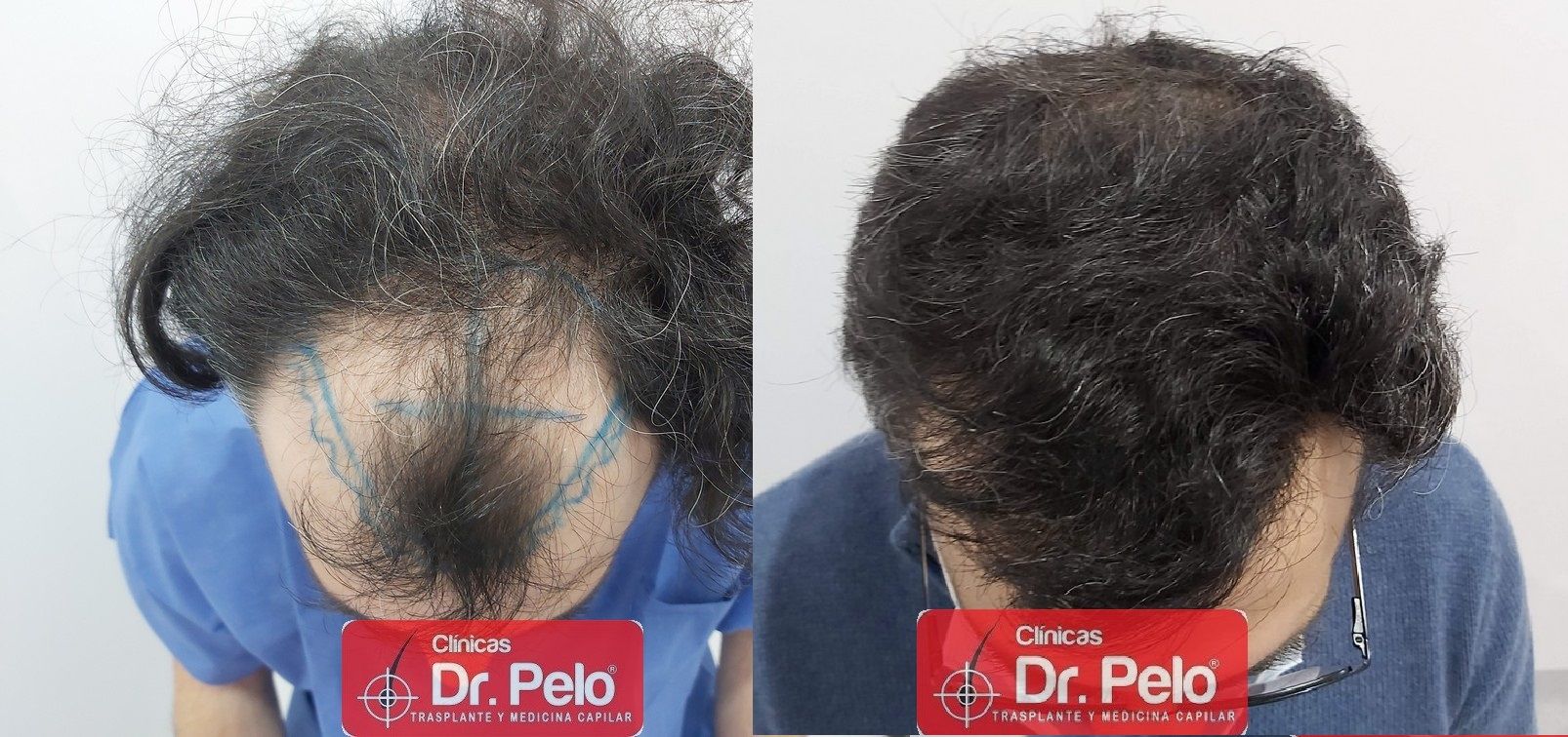 injerto capilar sevilla badajoz madrid cordoba albacete merida dr pelo