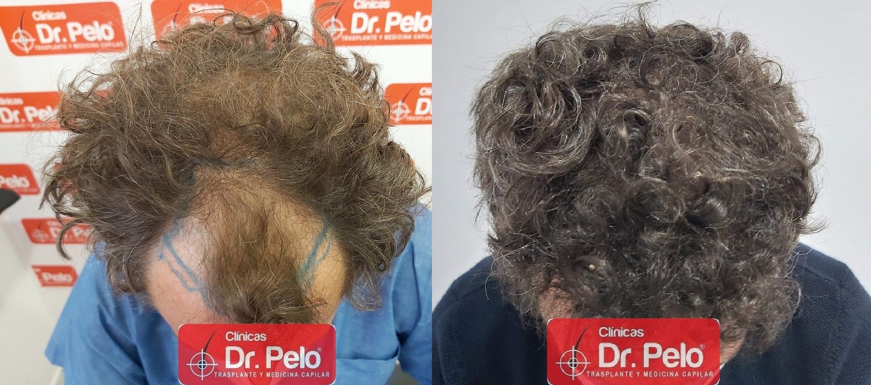 injerto capilar sevilla badajoz madrid cordoba albacete merida dr pelo