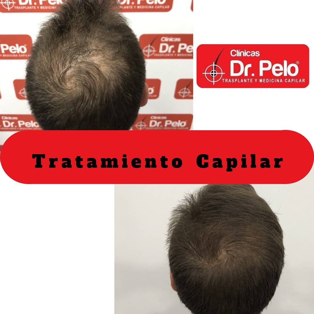 tratamiento capilar dr pelo