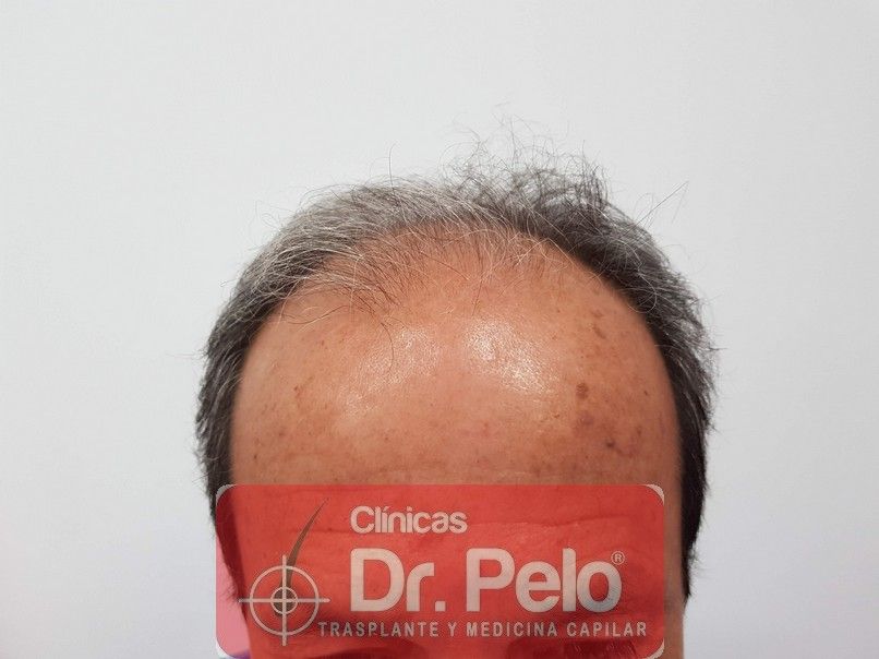 injerto capilar