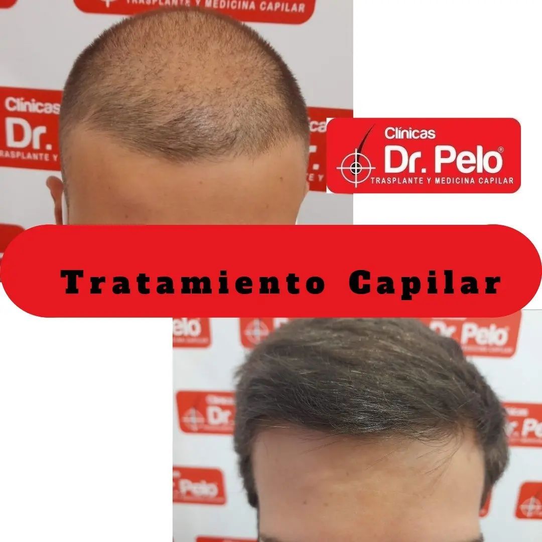 tratamiento capilar