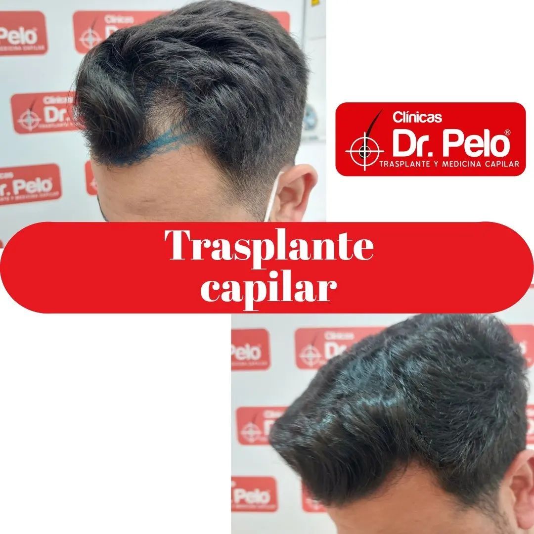 injerto capilar