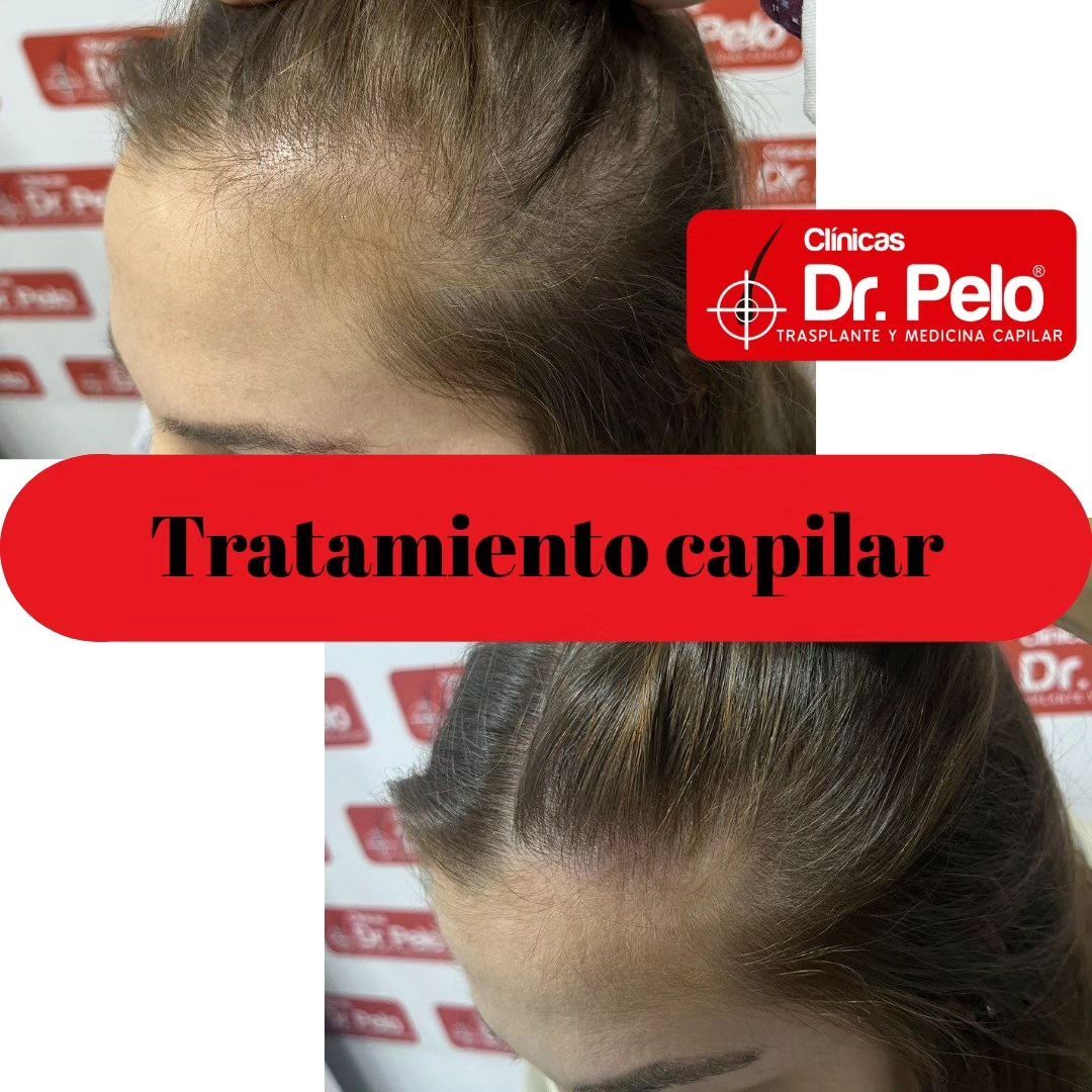 mmpcapilar