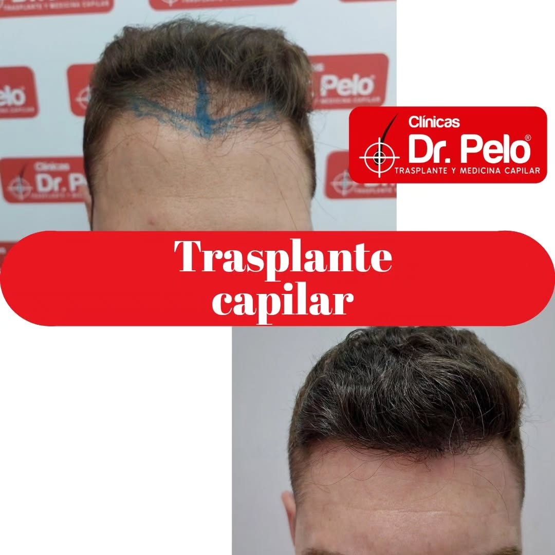 injerto capilar